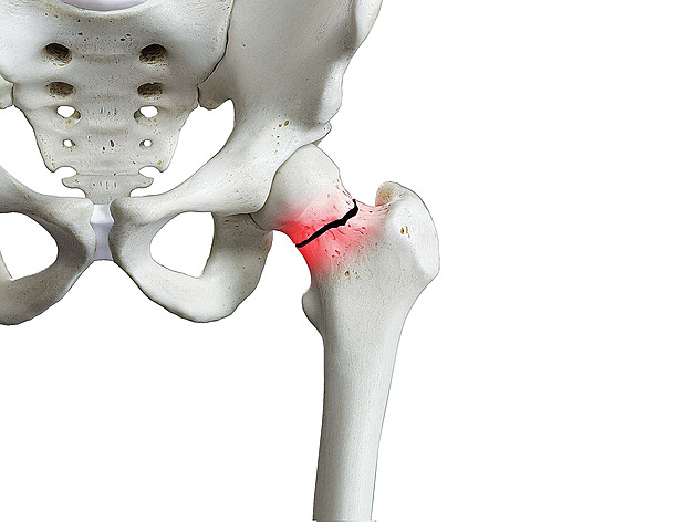 „Stokilová má jistou výhodu.“ Osteoporóza ohrožuje stále mladší ženy, varují lékaři