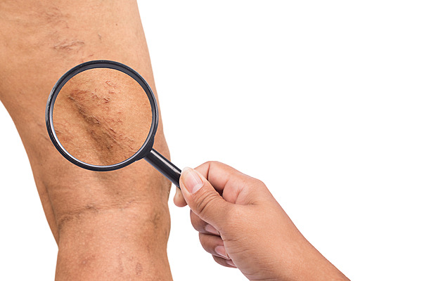 Česku chybějí specialisté na cévy, na jednoho připadá i 150 tisíc lidí