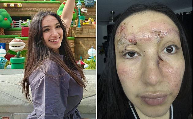 Žena si v autě nezapnula bezpečnostní pás, po nehodě zůstala zohyzděná