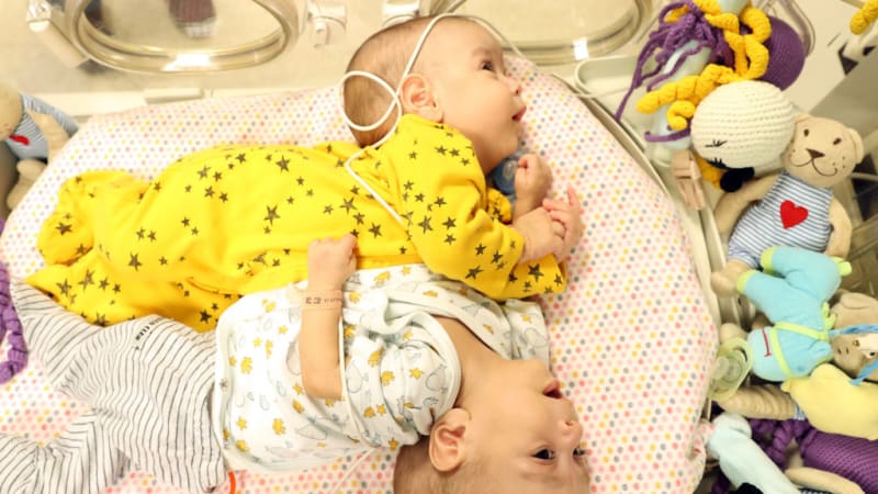Unikátní porod: Na svět přišla siamská dvojčata. V Bratislavě se chystá tisková konference