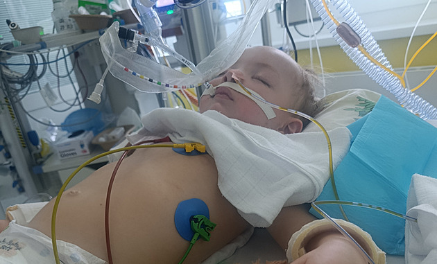Dvouletý chlapec vdechl kus hrušky, je v kómatu. Naději na uzdravení dává sbírka